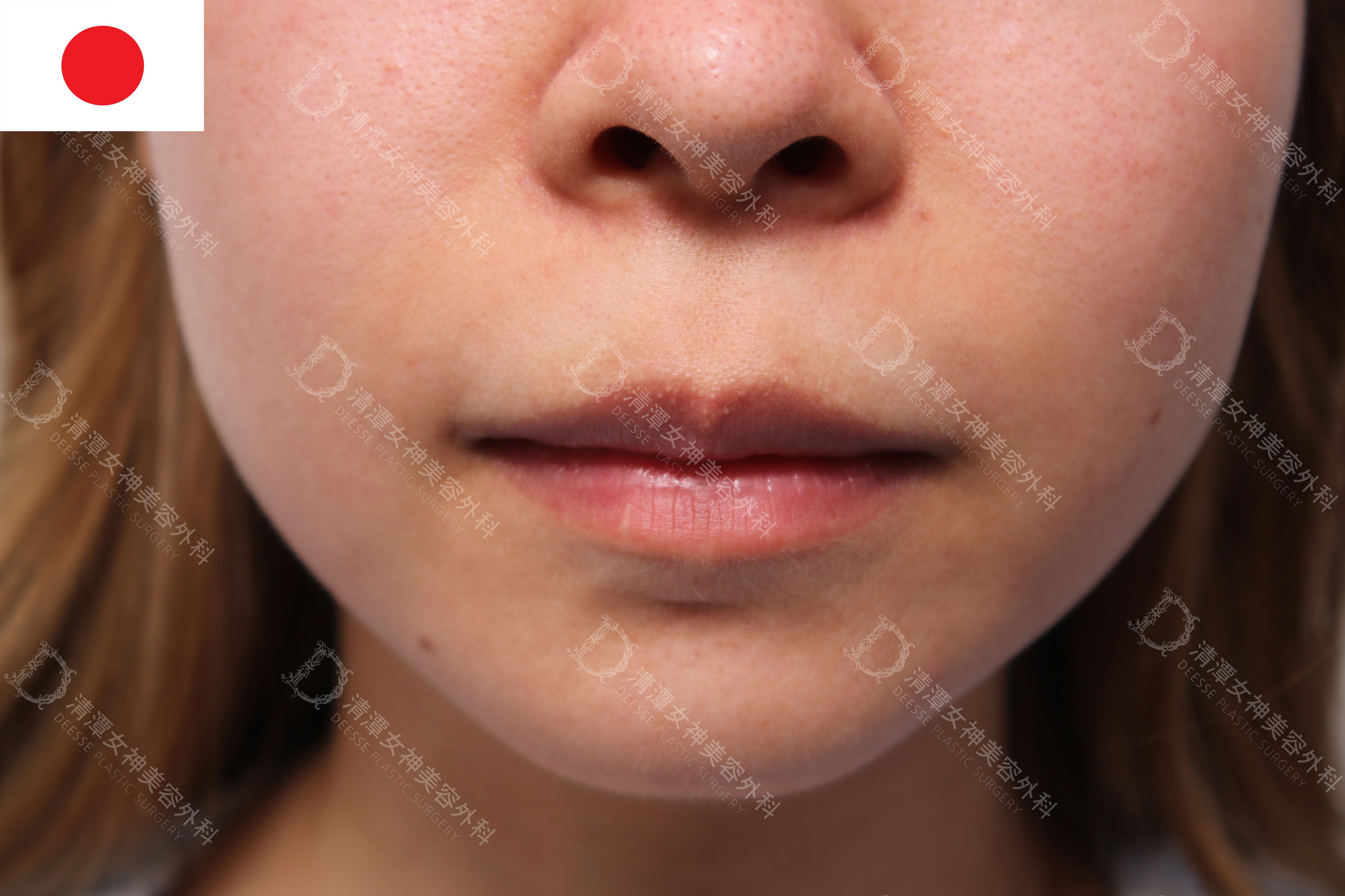 上唇を自然に薄くするM字リップ形成術｜症例写真・ビフォーアフター｜美容整形･美容外科のTAクリニックグループ